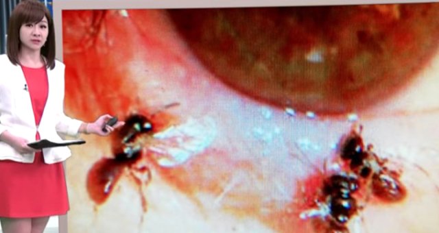Göz Yaşarması Şikayetiyle Hastaneye Giden Kadının Gözünden Canlı Arılar Çıktı