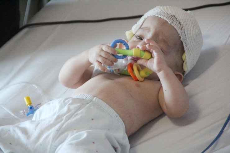 11 Aylık Bebeğe Kafa Şekil Bozukluğu Ameliyatı