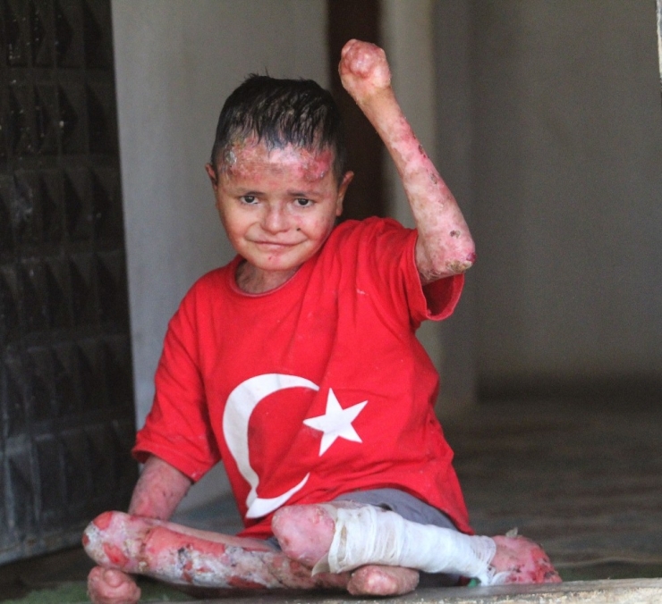 Suriyeli ’Kelebek’ Hastası Aladdin’in Türkiye Aşkı