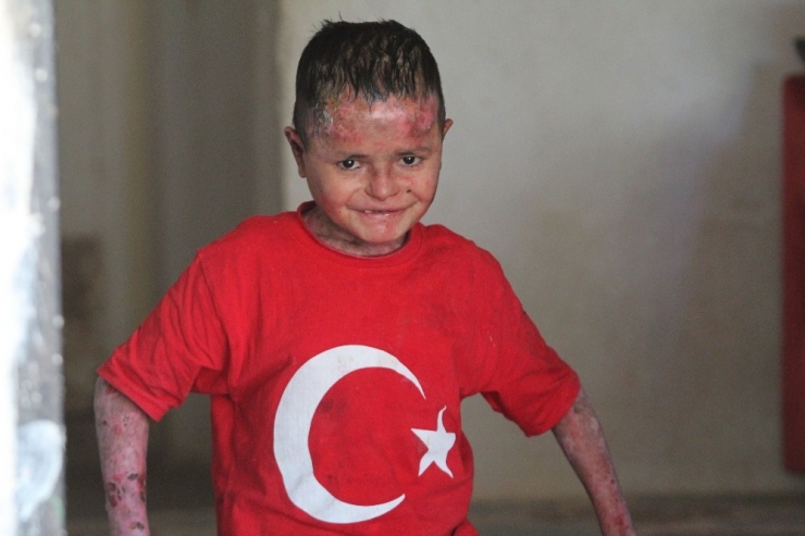 Suriyeli ’Kelebek’ Hastası Aladdin’in Türkiye Aşkı