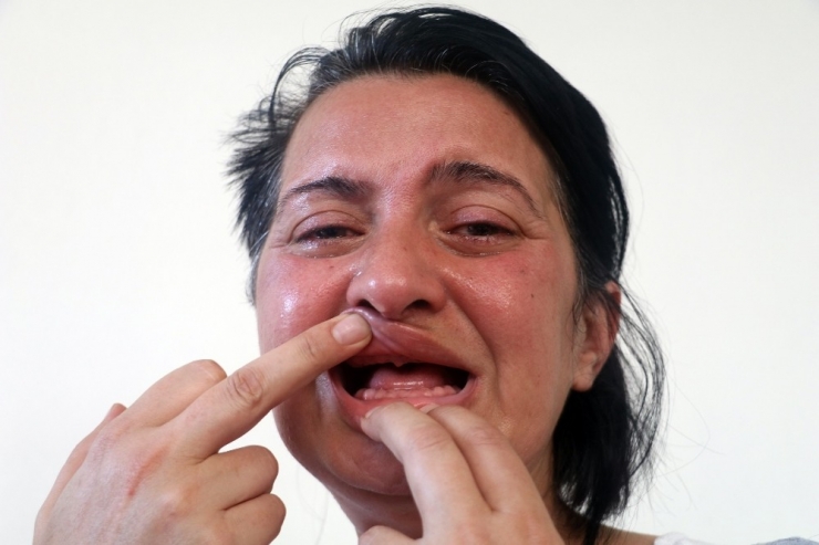 Beyaz Diş Hayaliyle 32 Dişinden Olan Kadının Başı Bu Sefer Unutkanlıkla Belada
