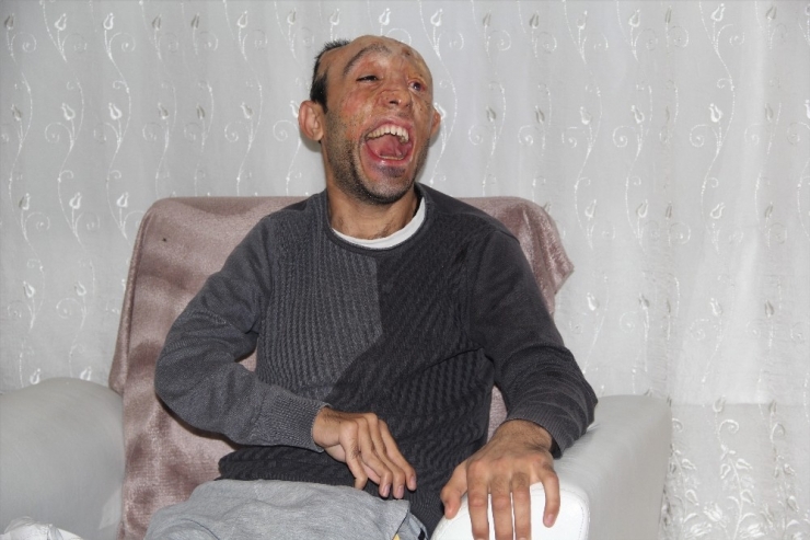 Vücudu Yanan Mehmet Ali’nin Dramı: Tek İsteği Yürüyebilmek Ve Konuşabilmek
