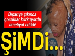 Hakkari'de yüzü ve kafası yanan 7 yaşındaki çocuk İstanbul’da ameliyat edildi