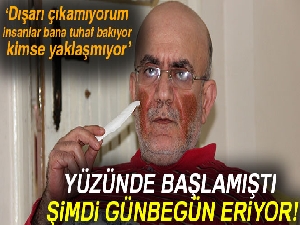 Yüzünde çıkan yaralar nedeniyle günden güne eriyor