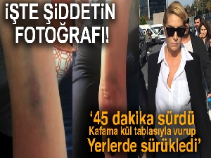 Sıla'nın darp sonucu vücudunda oluşan morlukların fotoğrafları ortaya çıktı