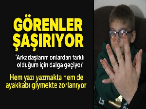 24 parmaklı çocuğun ayakkabı çilesi