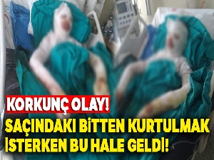 Liseli kız bitlenen saçlarını benzinle yıkamak isterken kendini yaktı