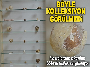Hastalardan çıkarılan böbrek taşları sergileniyor