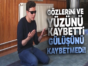 Gözlerini ve yüzünü kaybetti, gülüşünü kaybetmedi