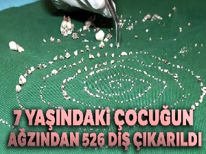 7 yaşındaki çocuğun ağzından 526 diş çıkarıldı