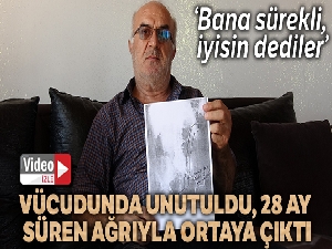 Ameliyatla vücuda 3 aylığına takılıp unutulan yarım metrelik tel, 28 ay süren ağrıyla ortaya çıktı