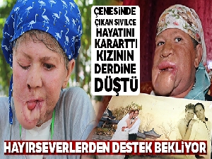 Çenesinde çıkan sivilce hayatını kararttı, kızının derdine düştü
