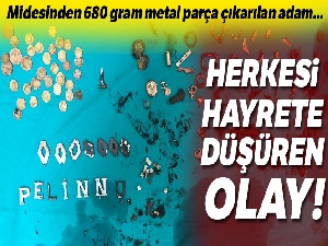 Doktorlar bile şaşırdı: 680 gram metal yutan adam öldü