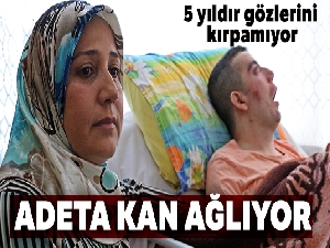 5 yıldır gözlerini kırpamıyor, adeta kan ağlıyor