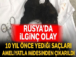 10 yıl boyunca yediği saçları ameliyatla midesinden çıkarıldı