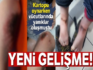 Kartopu oynarken yanan çocuklara doku nakli yapılacak
