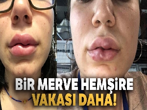 Dudak dolgusu yaptırdı hayatı karardı