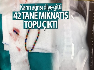 Karın ağrısıyla hastaneye giden çocuğun midesinden 42 adet mıknatıs topu çıktı