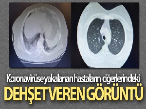 Koronavirüse yakalanan hastaların ciğerlerindeki dehşet veren görüntü