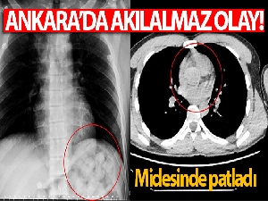 Karnından uyuşturucu zulası çıktı