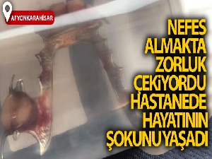 Nefes almakta zorluk çeken kadının boğazından bakın ne çıktı