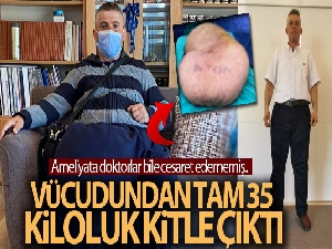 Bedeninden tam 35 kiloluk kitle çıktı