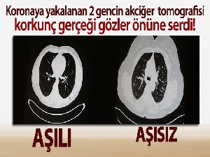 Aşılı ve aşısız olarak koronaya yakalanan 2 gencin akciğer tomografisi gerçeği gözler önüne serdi