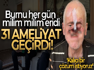 Burnu her gün milim milim eridi, 31 ameliyat geçirdi