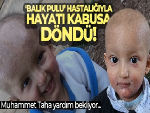 'Balık pulu' hastalığıyla yaşayan çocuğun hayatı kabusa döndü
