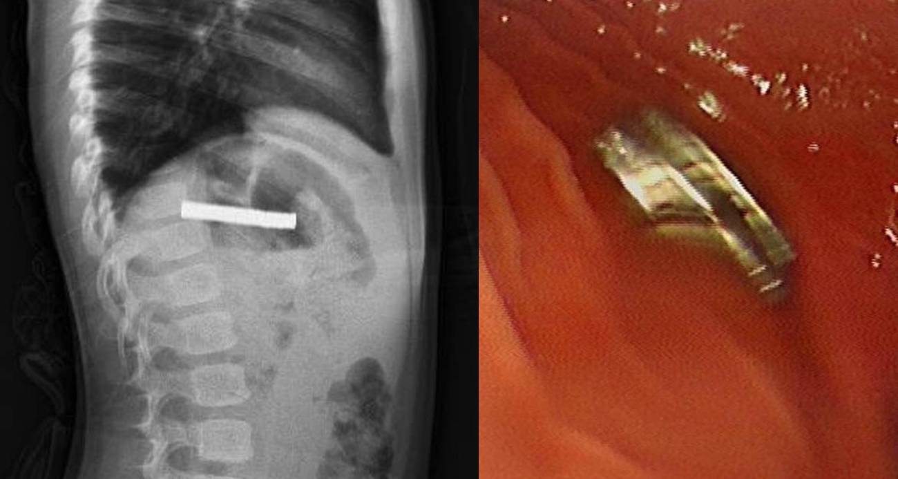 Çocuğun boğazından 19 adet mıknatıs çıkartıldı
