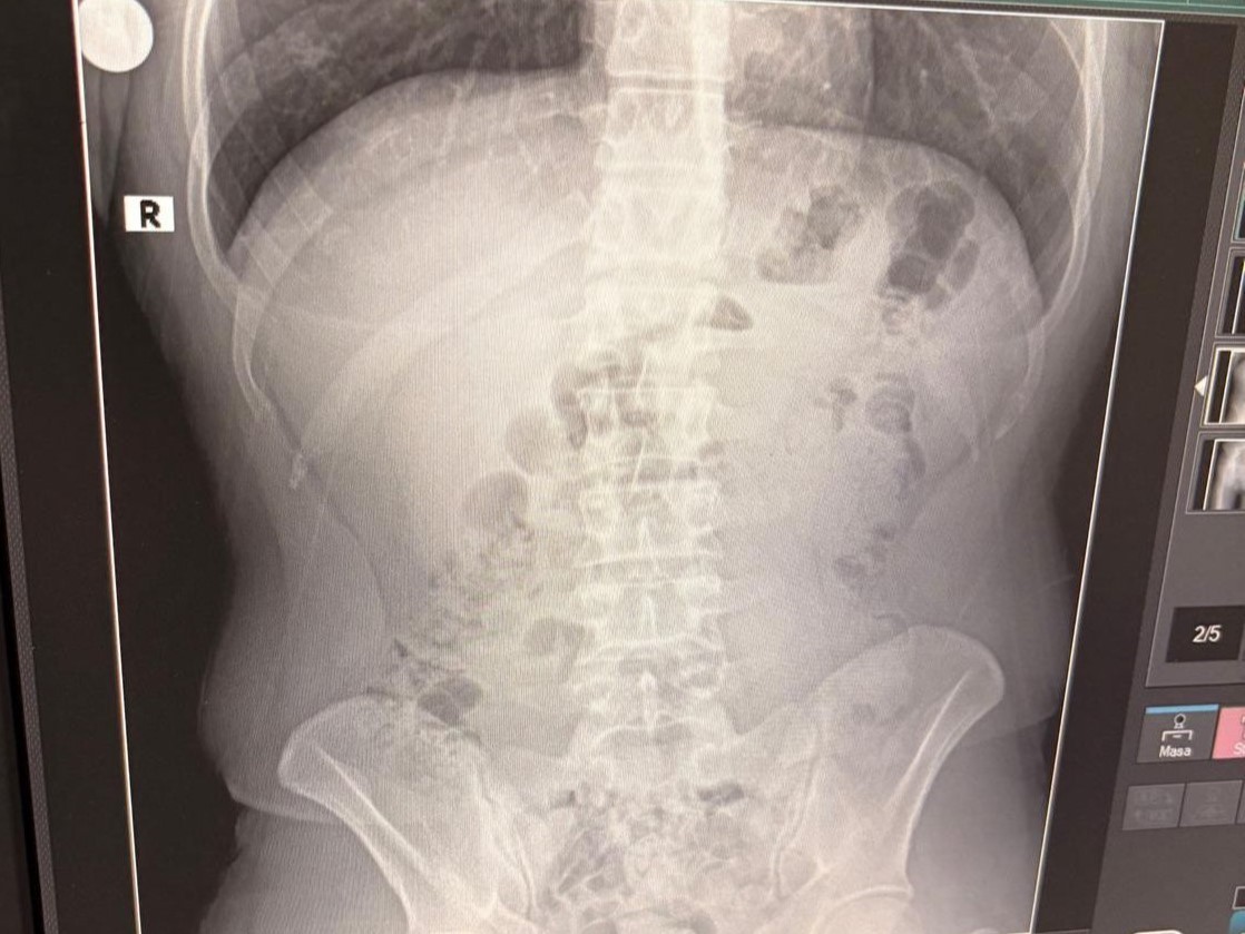 Uşak’ta midelerinden uyuşturucu çıktı: İranlı 3 kişi tutuklandı