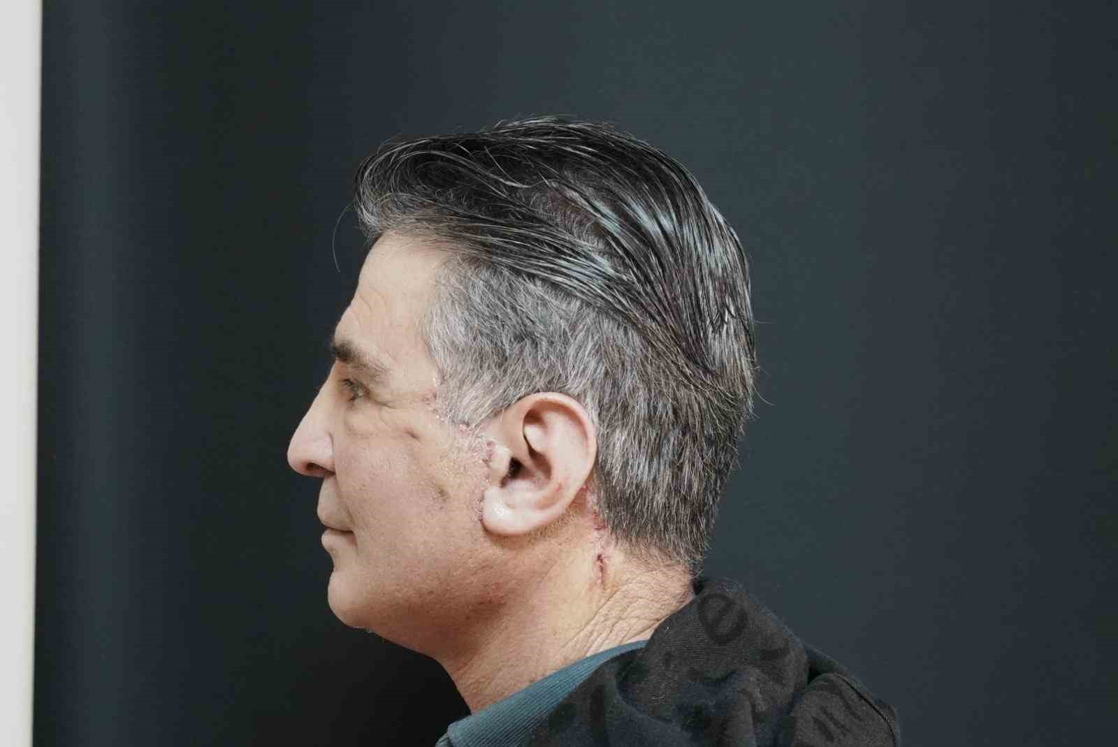 Bitlis’te ilk defa yüz germe ameliyatı başarıyla yapıldı