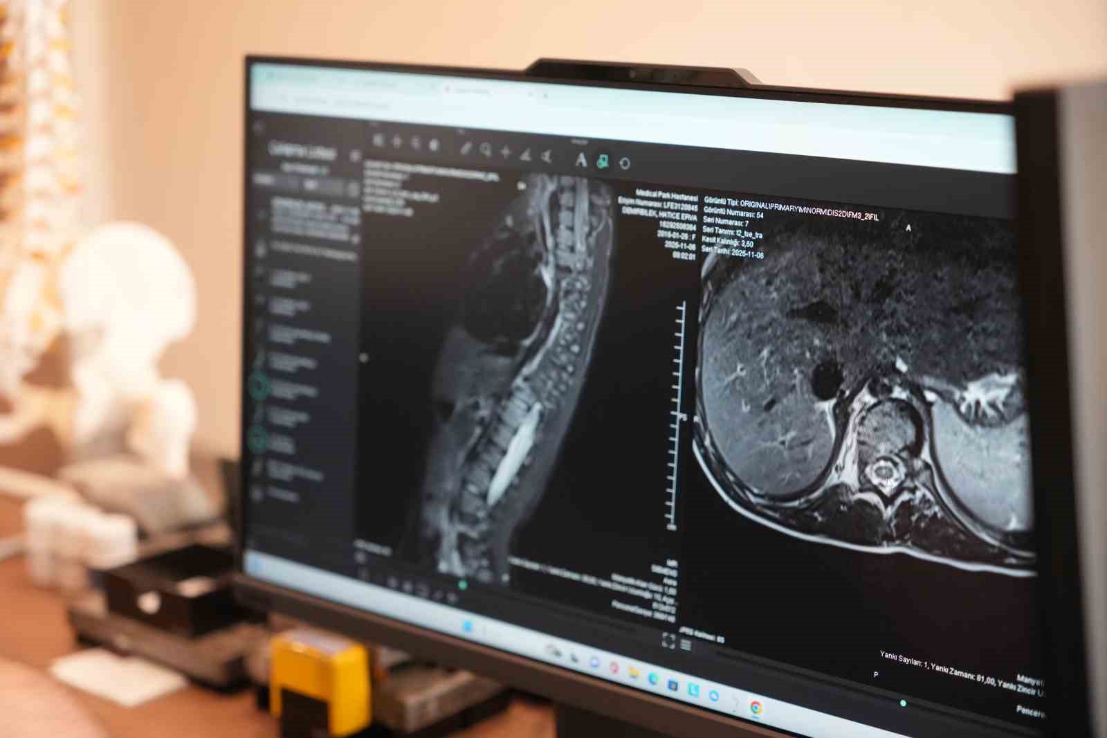 Sinsi ilerleyen bu rahatsızlığı ilk fark eden anneler oluyor