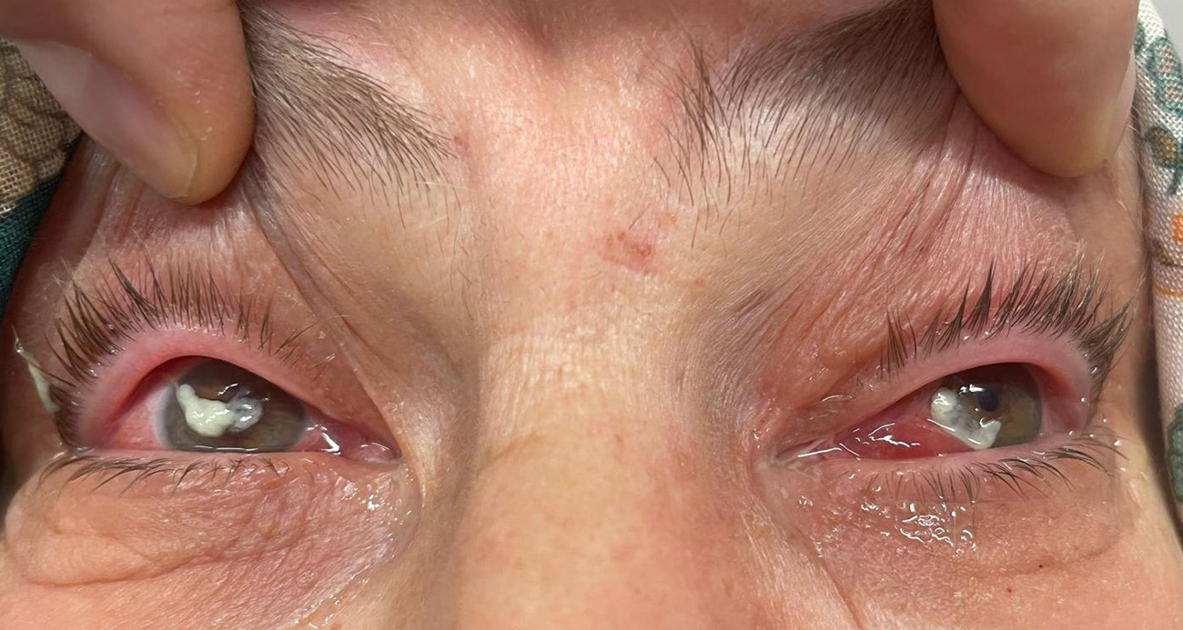 ’Kırlangıç otu kullanımı’na dikkat, uzmanlar uyarıyor: 