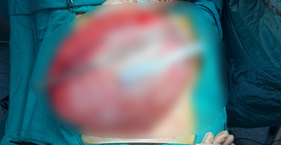 Kilo vermek için hastaneye giden çocuğun karnından 3,5 kiloluk kist çıktı