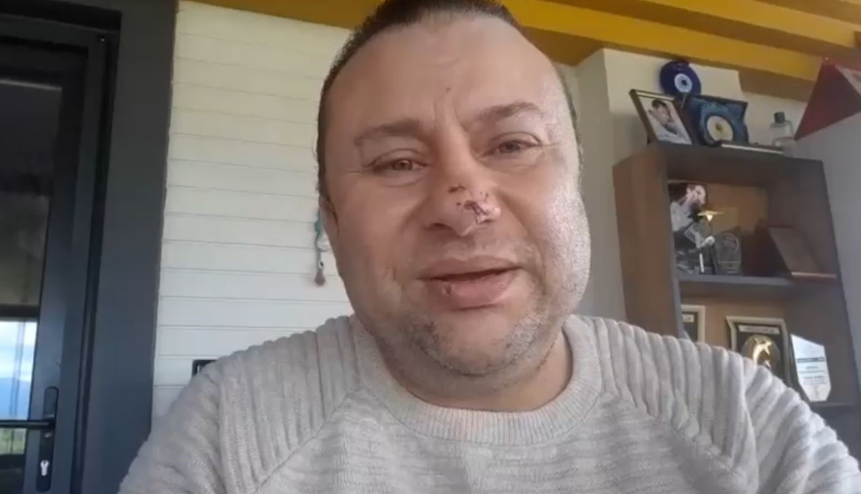 Pitbull saldırısına uğrayan Onur Akay o anları anlattı: 