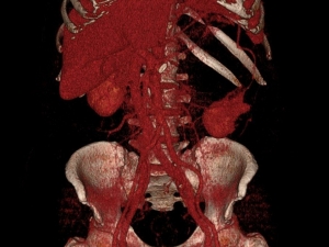 Sessiz Gelen Tehlike: "Böbrek Kanseri"