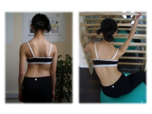 Skolyoz Tedavisinde Geç Kalmayın