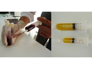 Diz Kireçlenmesinde Prp İle Kök Hücre Tedavisi Karşılaştırması