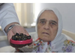 Safra Kesesinden Çıkan Taşlar Doktorları Bile Şaşkına Çevirdi