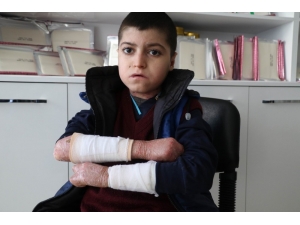 Kelebek Hastası Çocuklar, Kendilerine Uygun Olmayan Köpüklü Sargı Bezini, Derilerine Yapıştığı İçin Kullanamıyor