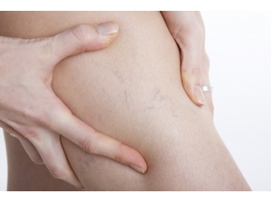 Hayat Kalitesini Düşüren Sinsi Düşman; Varis Ve Tedavi Yöntemleri