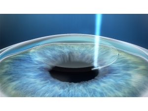 Lazerle Göz Tedavilerinde 3. Nesil Relex Smile Teknolojisi Dönemi