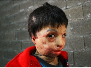 Esad’ın Varil Bombası 7 Yaşındaki Mahmud’u Yaktı