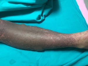 Psikiyatristin Verdiği İlaçla Yoğun Bakımlık Olan Genç Kızdan Sevindirici Haber