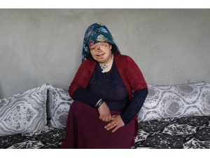 Yaşıtları Gelinlik Hayali Kuruyor, O Yanık Yüzünden Kurtulmak İstiyor