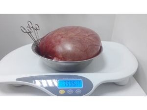 Karnından 7,5 Kiloluk Kist Çıktı