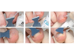 Opr. Dr. İdris Elmas, Batık Tırnak Bakımı Hakkında Bilgiler Verdi