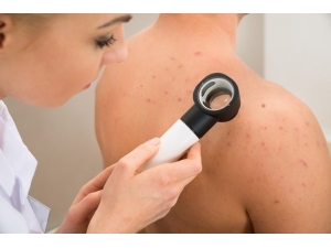 Cilt Lekelerini Önlemede Öncelik Güneşten Korunmak