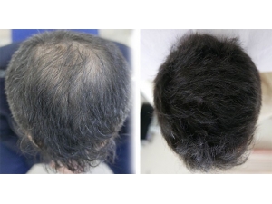 Saç Nakli Tarihe Karışıyor